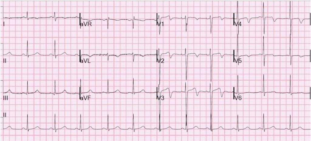 Abnormal EKG