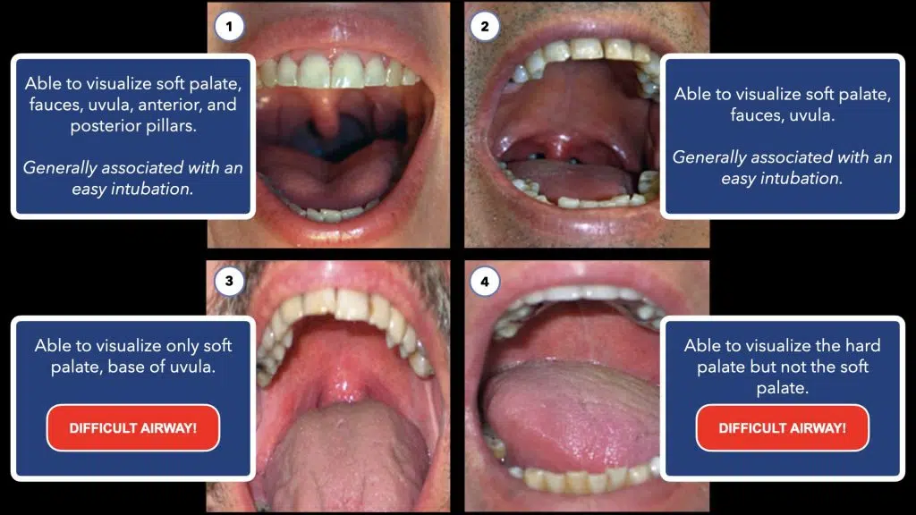 Advanced and Difficult Airway Course for Physician Assistants