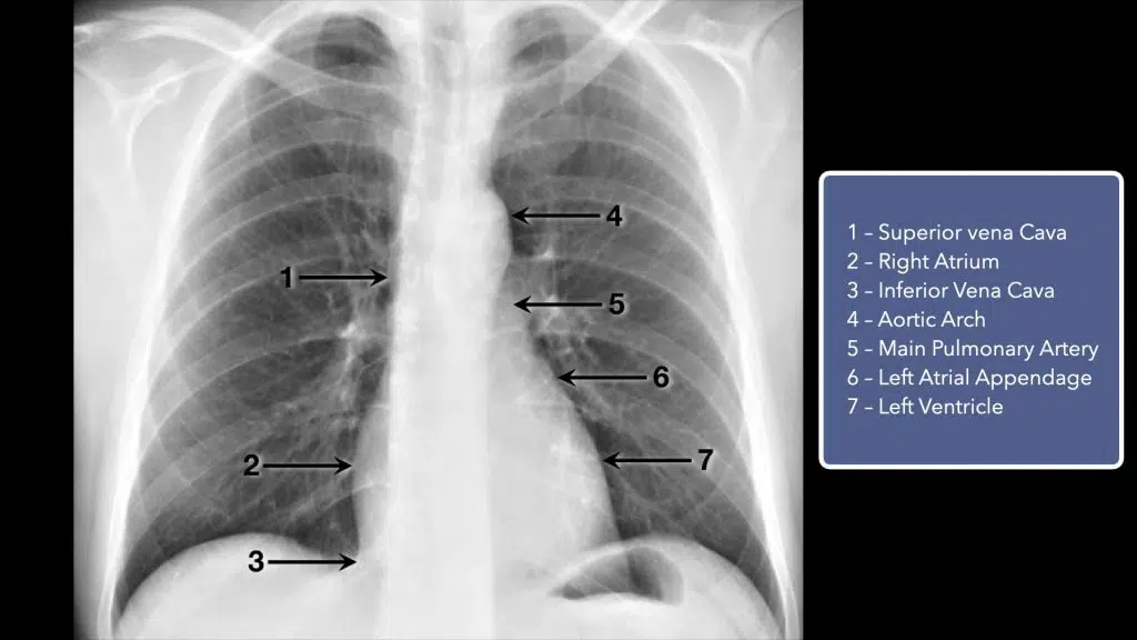 Chest radiograph cardiac silohuette