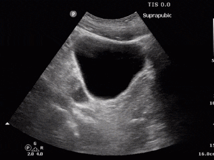 Focused assessment with sonography for trauma - Wikipedia