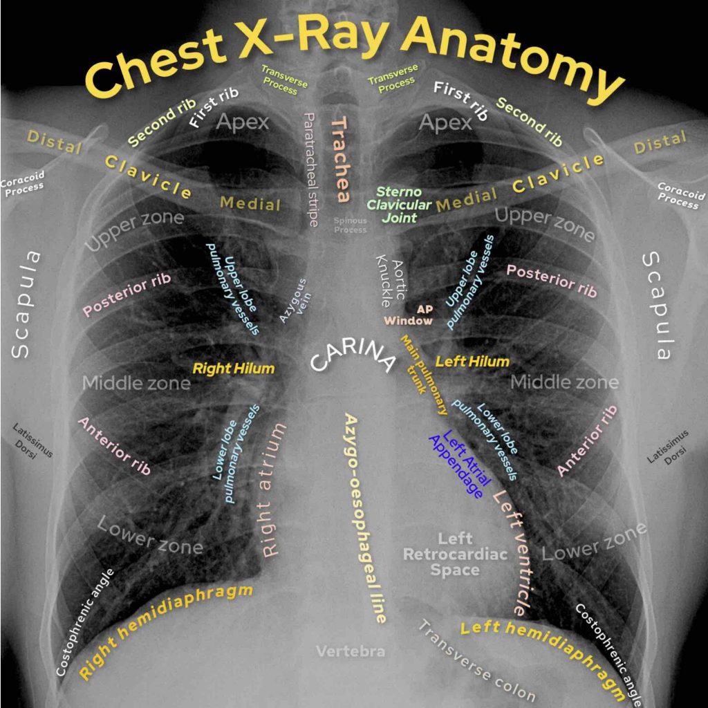 How To Read Chest X Ray Chest X Ray Normal Anatomy Chest X Ray Pa 