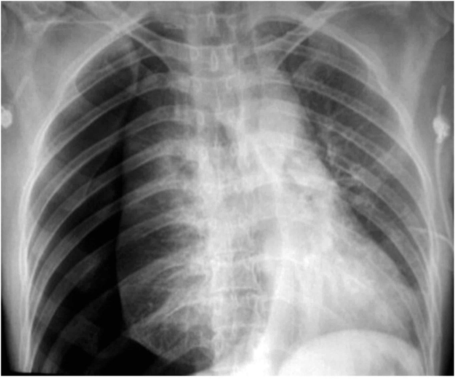 Basic Chest X-Ray Interpretation - Tips and pointers to see it all!