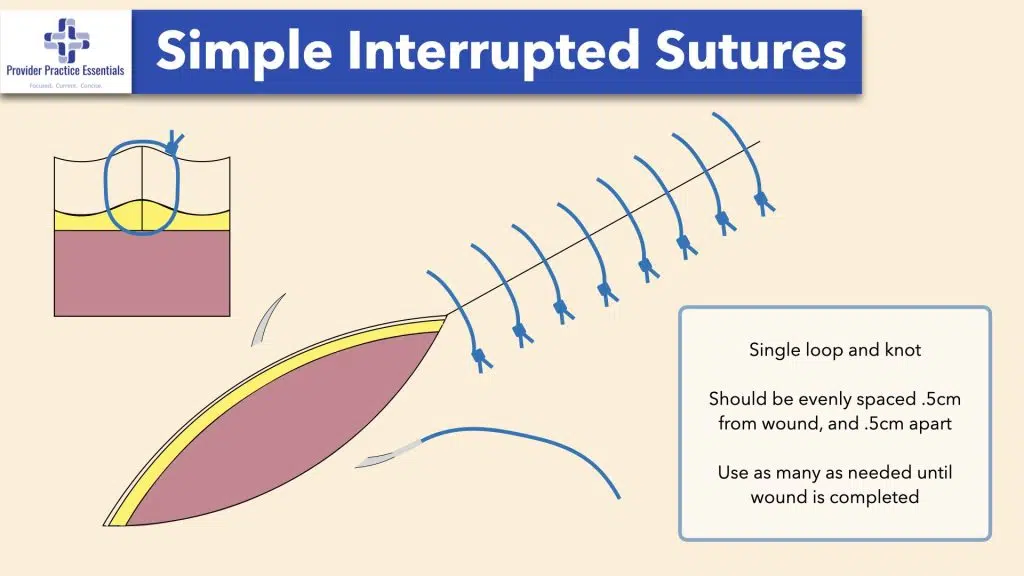 Simple interupted deals suture