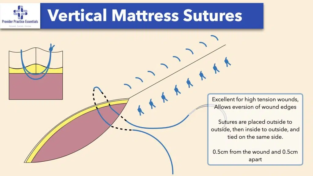 Wound Closure Techniques